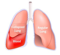 Hemothorax