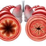 Respiratory Emergencies